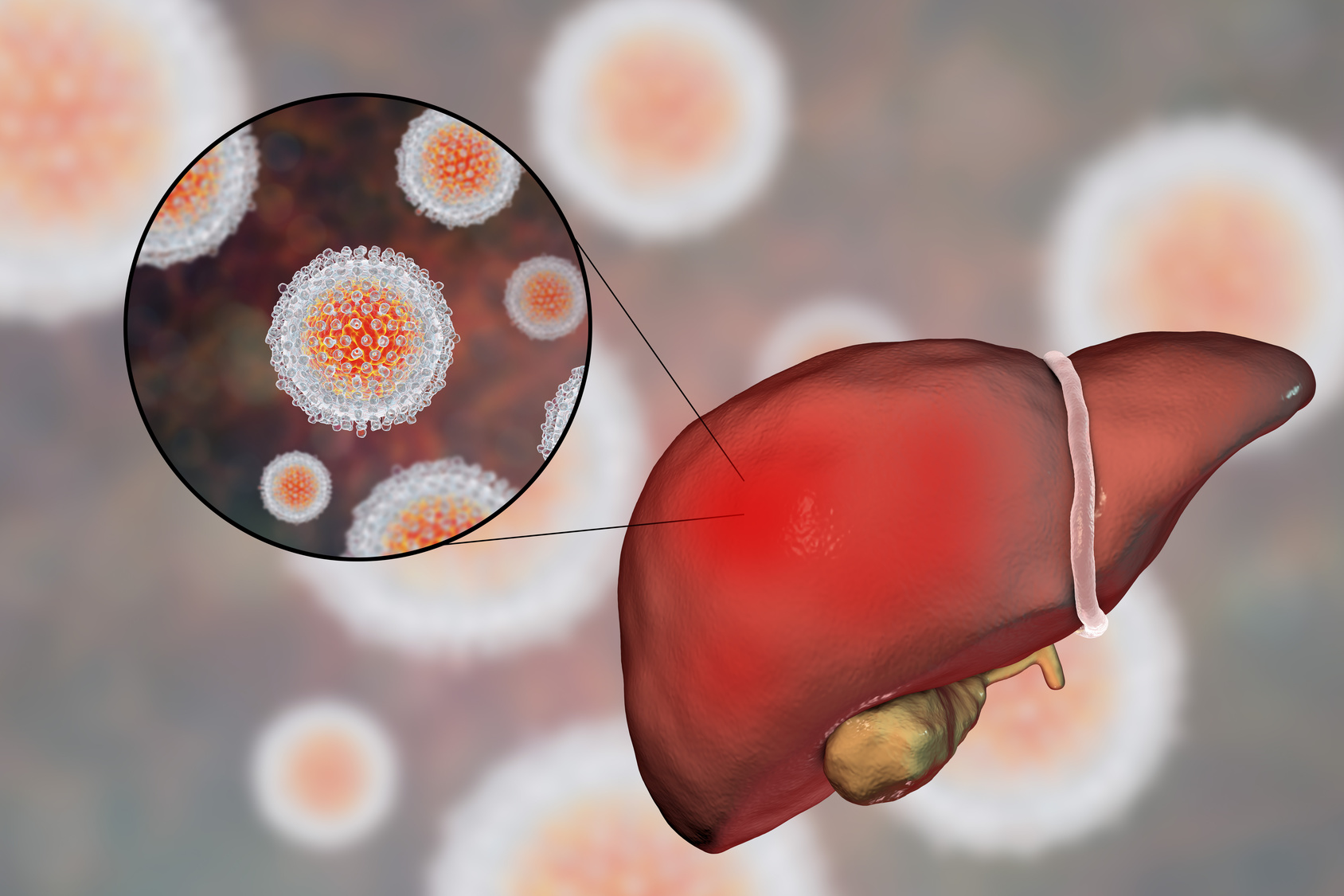 New research consortium to develop new liver cancer