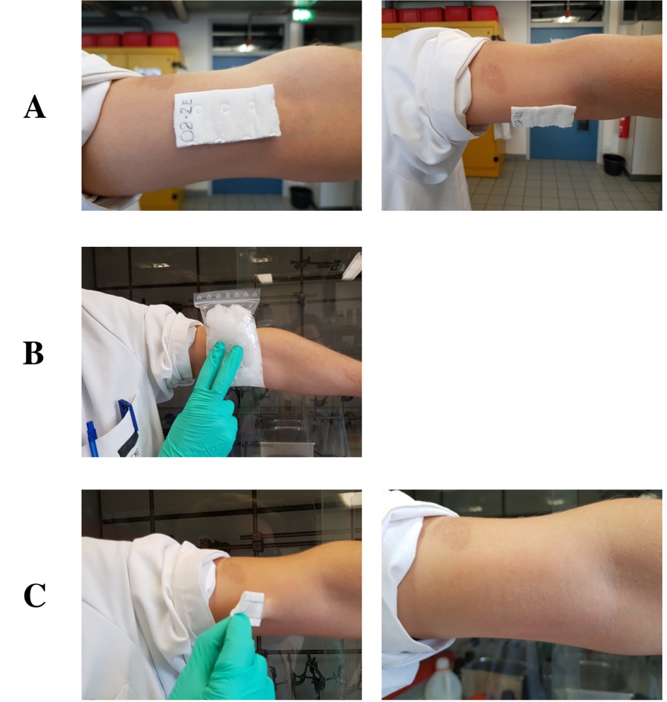 In the top row, two photos show how the dressing sticks to the sensitive inside of an upper arm, in the centre the adherent dressing is cooled with an ice pack and the bottom row shows the removal and the undamaged skin after application.