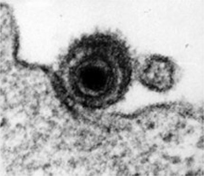 Das Bild zeigt eine elektronenmikroskopische Aufnahme eines EBV-Viruspartikels auf der Oberfläche eines Lymphozyten.