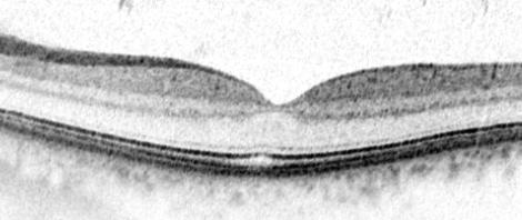 OCT image with retinal layers in different shades of grey, from very dark to light.