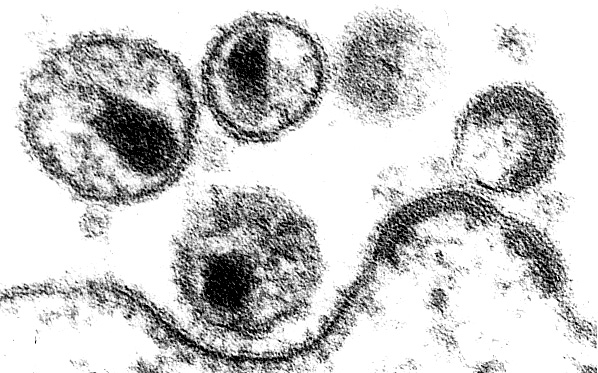 Electron micrograph of AIDS viruses on the membrane of a cell.