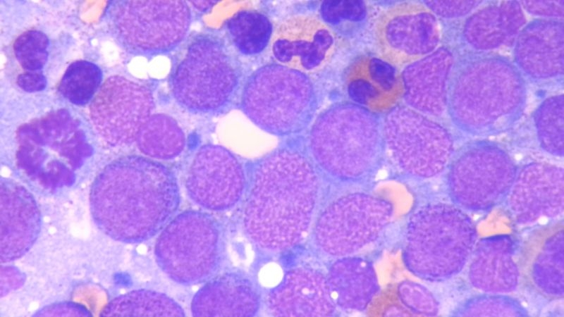 Haematoxylin-eosin stained diseased bone marrow smear. The image shows different cell types.