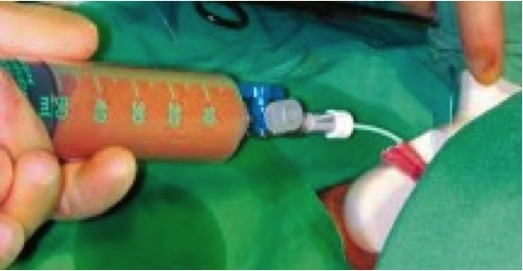 The photo shows a big syringe with which a liver cell suspension is injected into the patient's portal vein.