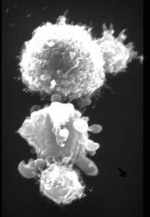 Zu sehen ist in einer mikrokopischen Aufnahme, wie zwei T-Zellen zwei Tumorzellen attackieren.